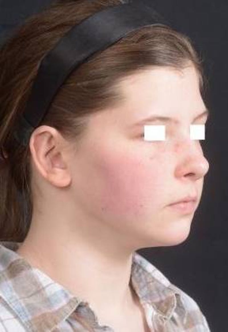 Otoplasty Before & After Gallery - Patient 179716 - Image 8