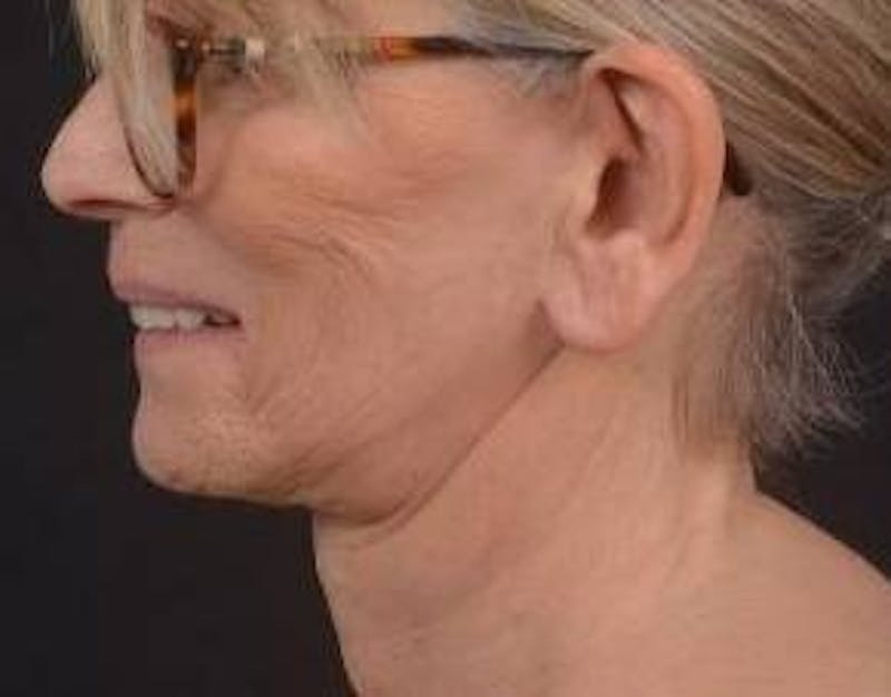 Otoplasty Before & After Gallery - Patient 202226 - Image 3