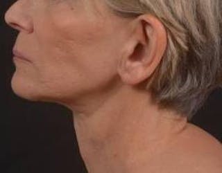 Otoplasty Before & After Gallery - Patient 202226 - Image 4