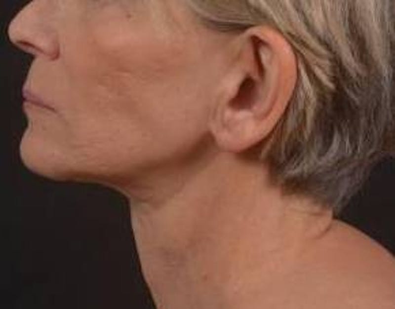 Otoplasty Before & After Gallery - Patient 202226 - Image 4