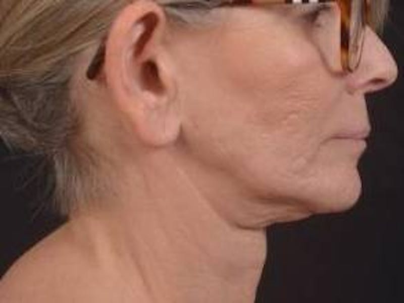 Otoplasty Before & After Gallery - Patient 202226 - Image 5