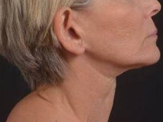 Otoplasty Before & After Gallery - Patient 202226 - Image 6