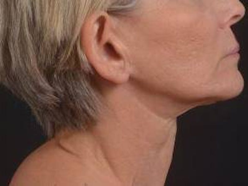 Otoplasty Before & After Gallery - Patient 202226 - Image 6