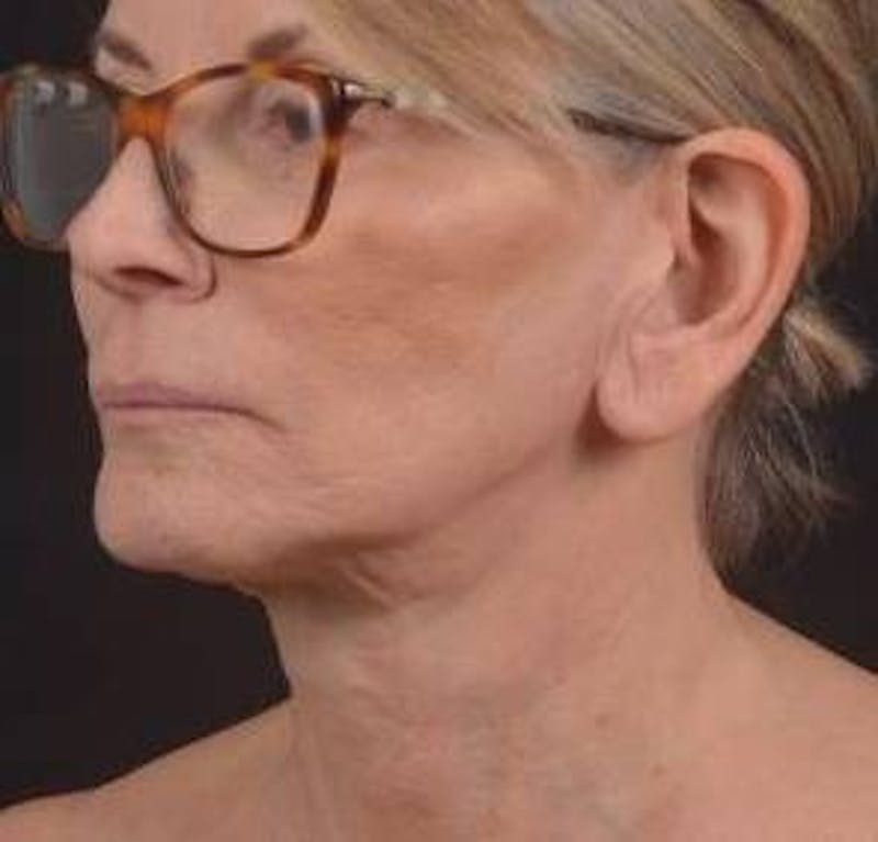 Otoplasty Before & After Gallery - Patient 202226 - Image 7
