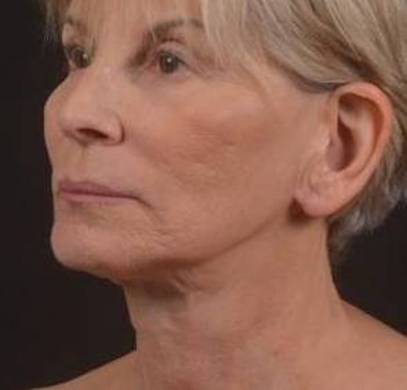 Otoplasty Before & After Gallery - Patient 202226 - Image 8