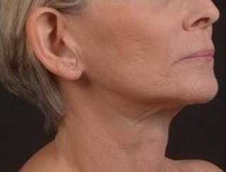 Otoplasty Before & After Gallery - Patient 202226 - Image 10