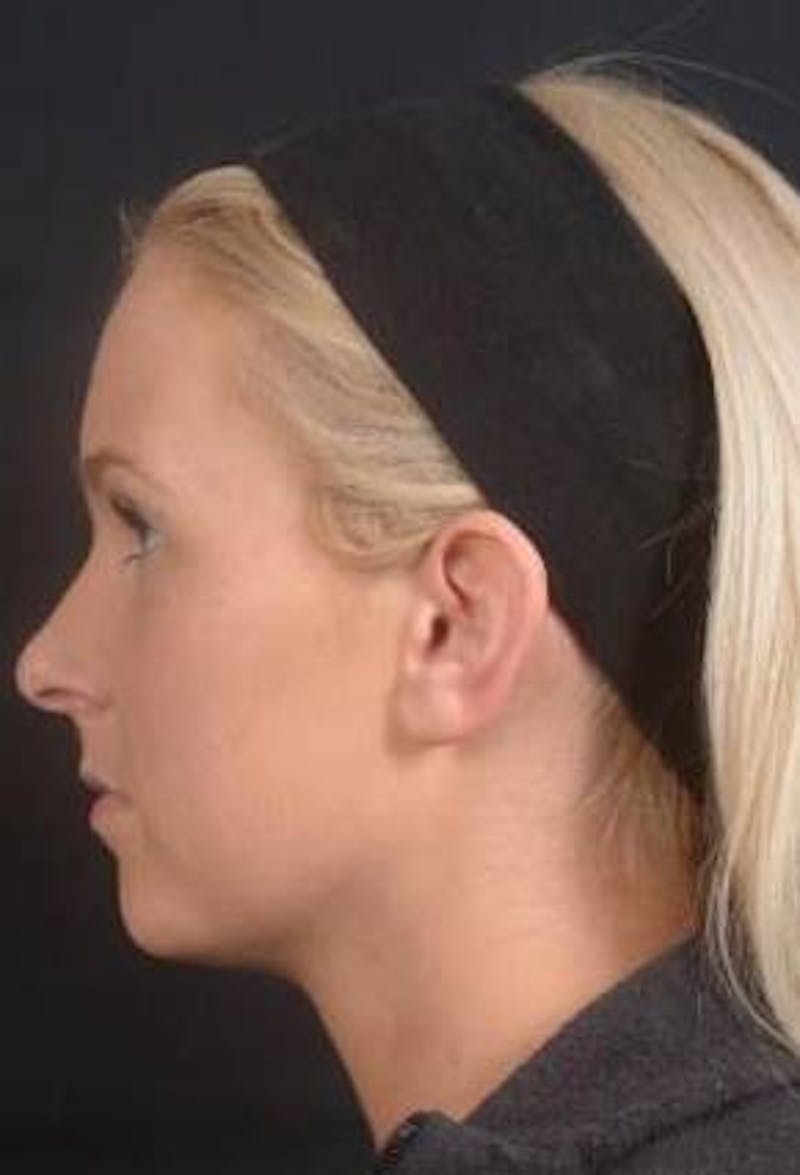 Otoplasty Before & After Gallery - Patient 335882 - Image 3