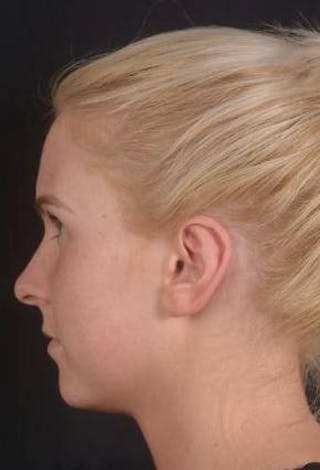 Otoplasty Before & After Gallery - Patient 335882 - Image 4