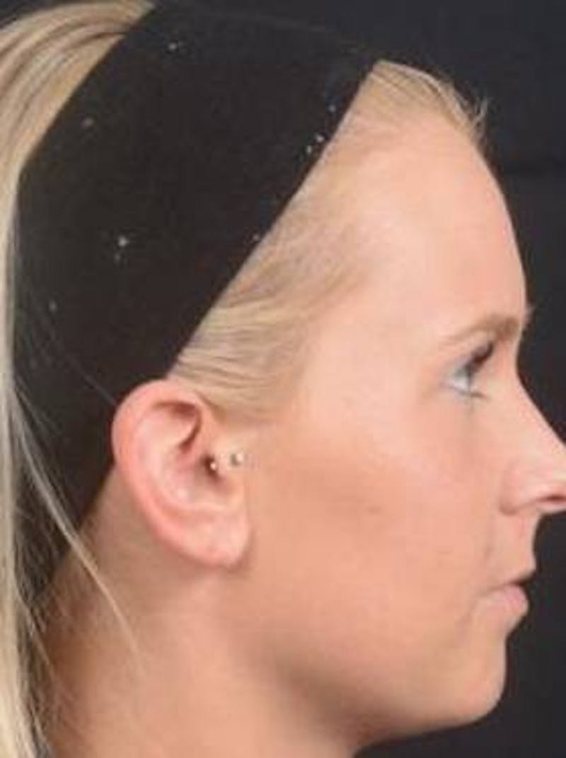 Otoplasty Before & After Gallery - Patient 335882 - Image 5