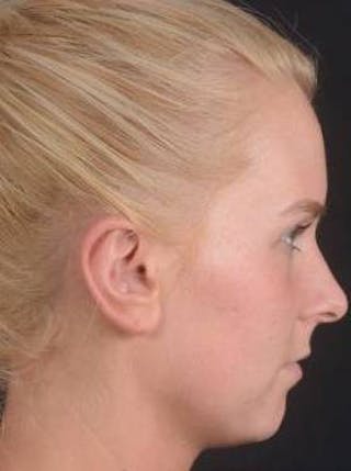 Otoplasty Before & After Gallery - Patient 335882 - Image 6