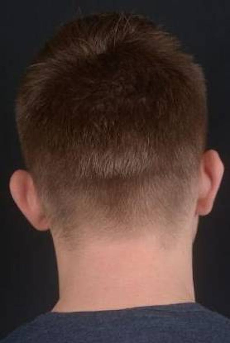 Otoplasty Before & After Gallery - Patient 204573 - Image 3