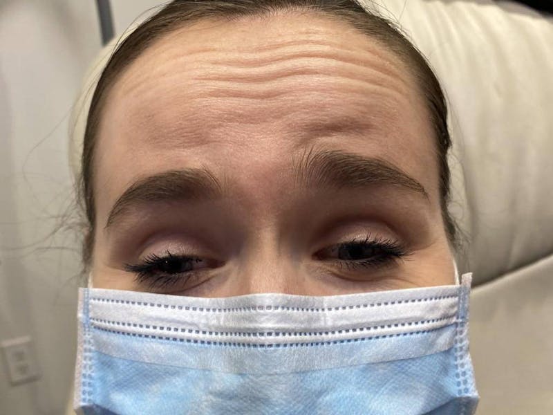 Botox Before & After Gallery - Patient 999721 - Image 3