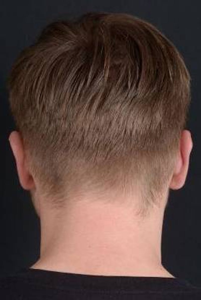 Otoplasty Before & After Gallery - Patient 204573 - Image 4
