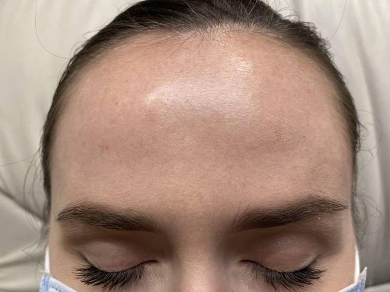 Botox Before & After Gallery - Patient 999721 - Image 4