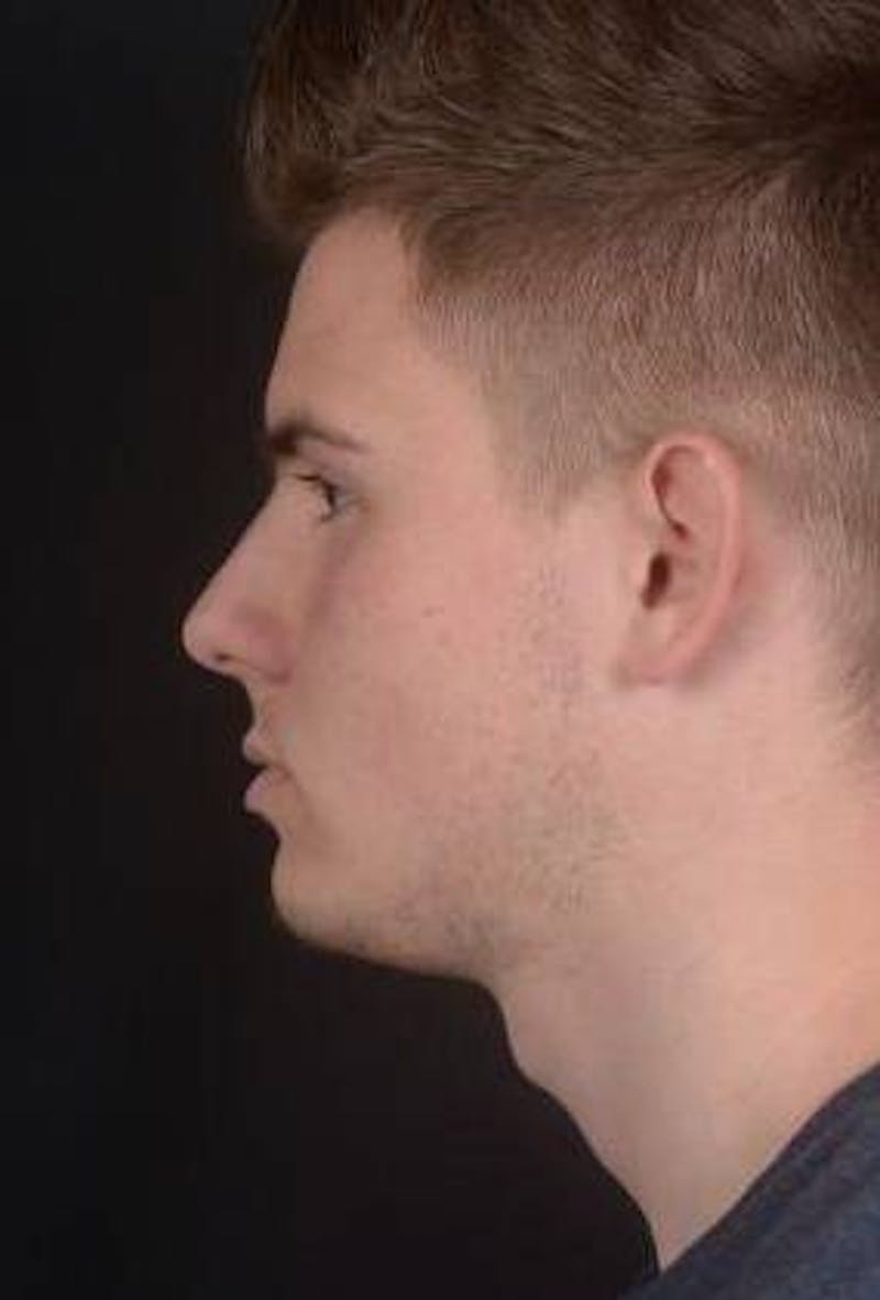 Otoplasty Before & After Gallery - Patient 204573 - Image 5