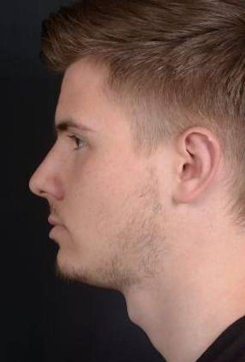 Otoplasty Before & After Gallery - Patient 204573 - Image 6