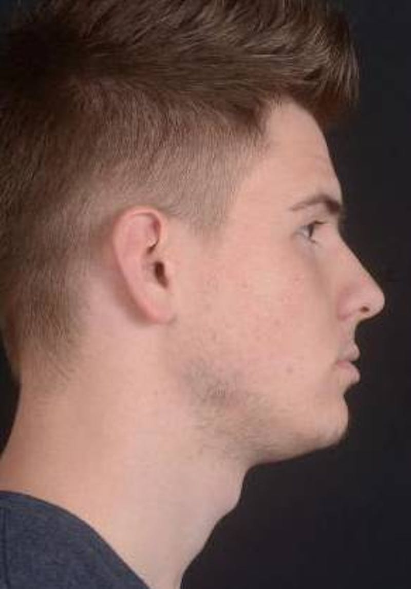Otoplasty Before & After Gallery - Patient 204573 - Image 7