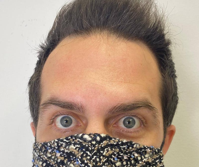 Botox Before & After Gallery - Patient 100573 - Image 4