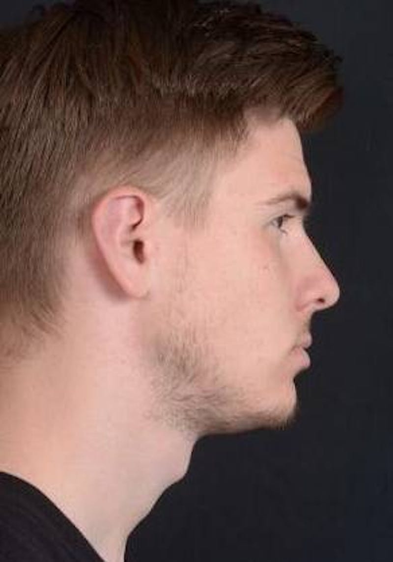 Otoplasty Before & After Gallery - Patient 204573 - Image 8