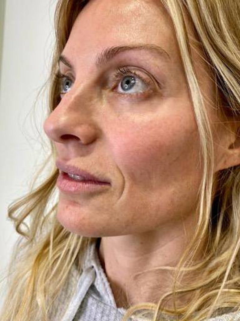 Lip Filler Before & After Gallery - Patient 419909 - Image 3