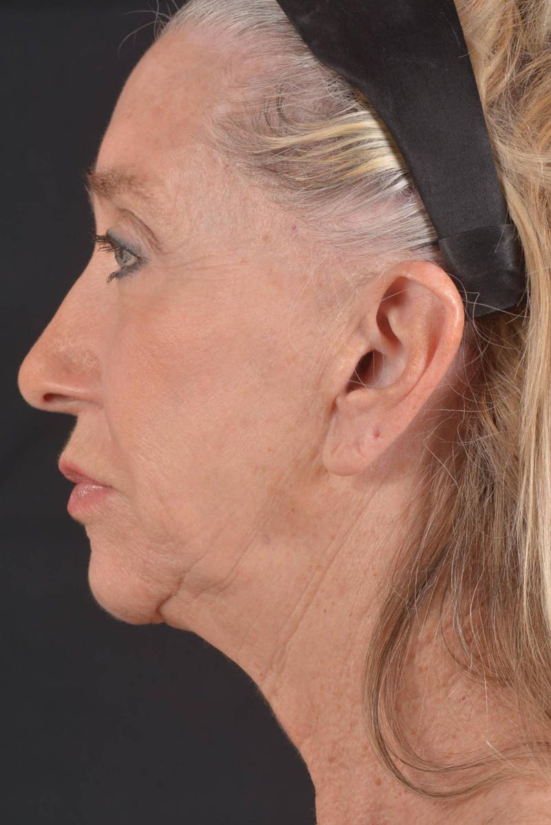 Facelift Before & After Gallery - Patient 262486 - Image 3