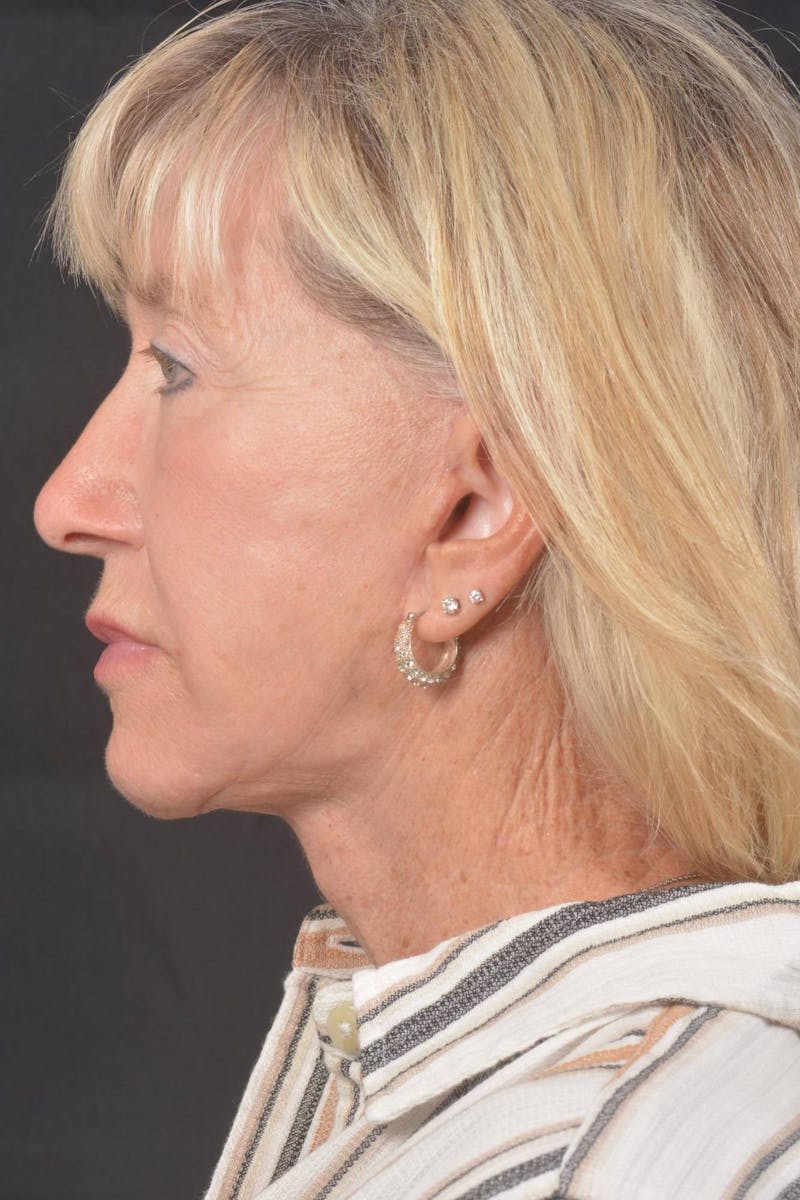 Facelift Before & After Gallery - Patient 262486 - Image 4