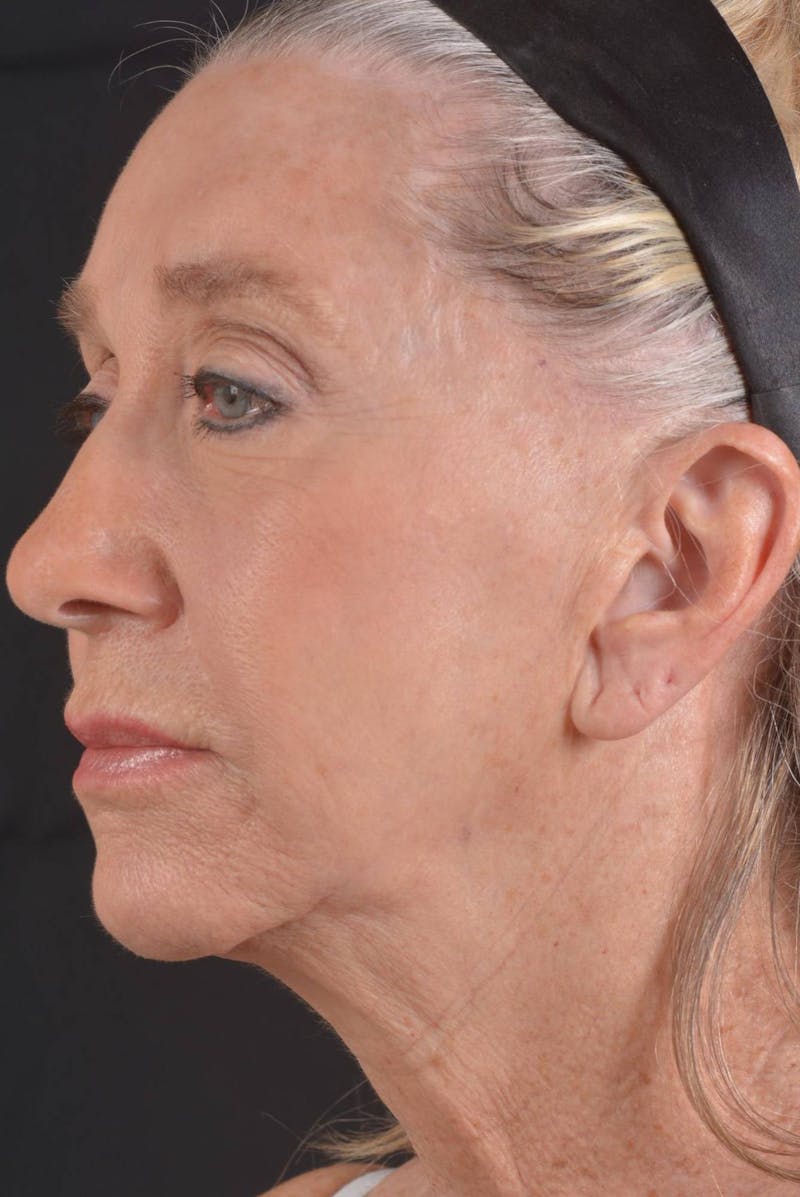 Facelift Before & After Gallery - Patient 262486 - Image 7