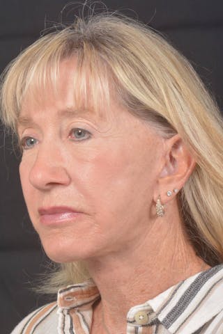 Facelift Before & After Gallery - Patient 262486 - Image 8