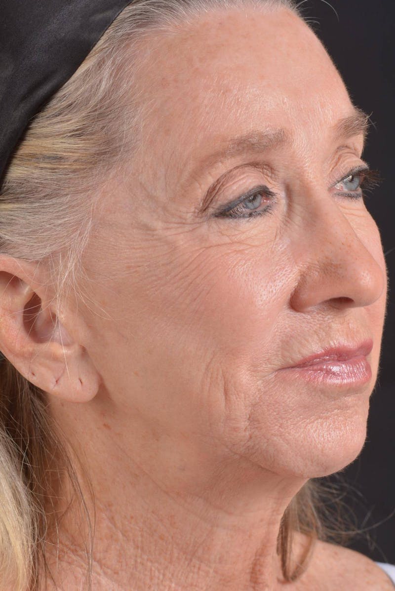 Facelift Before & After Gallery - Patient 262486 - Image 9
