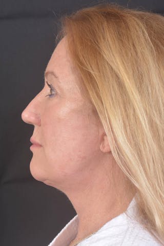 Facelift Before & After Gallery - Patient 132202 - Image 4