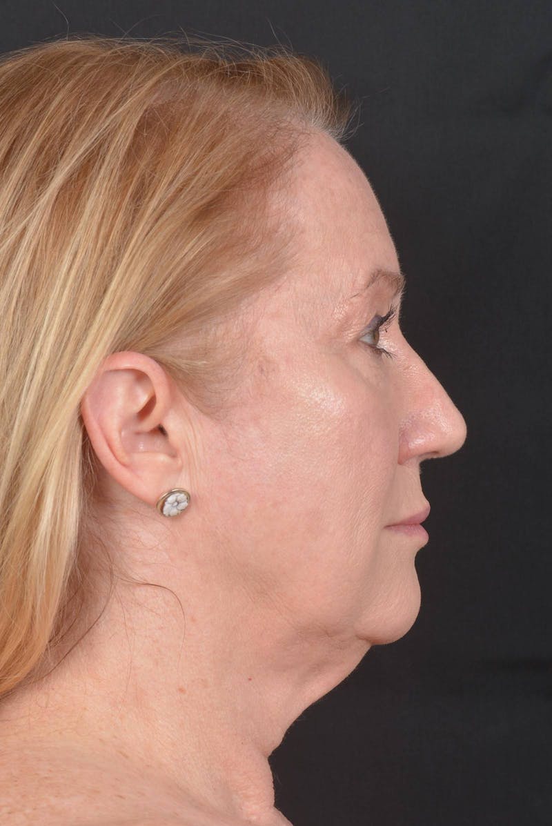 Facelift Before & After Gallery - Patient 132202 - Image 5