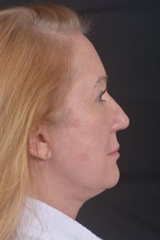 Facelift Before & After Gallery - Patient 132202 - Image 6