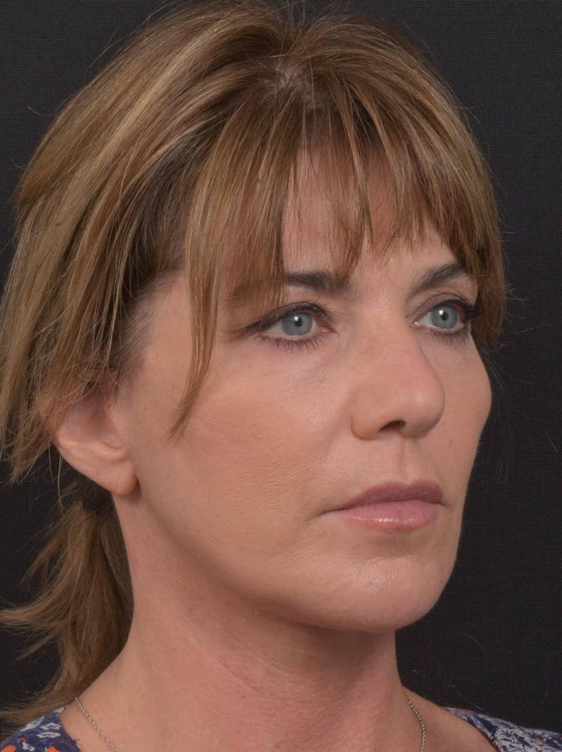 Facelift Before & After Gallery - Patient 753205 - Image 10