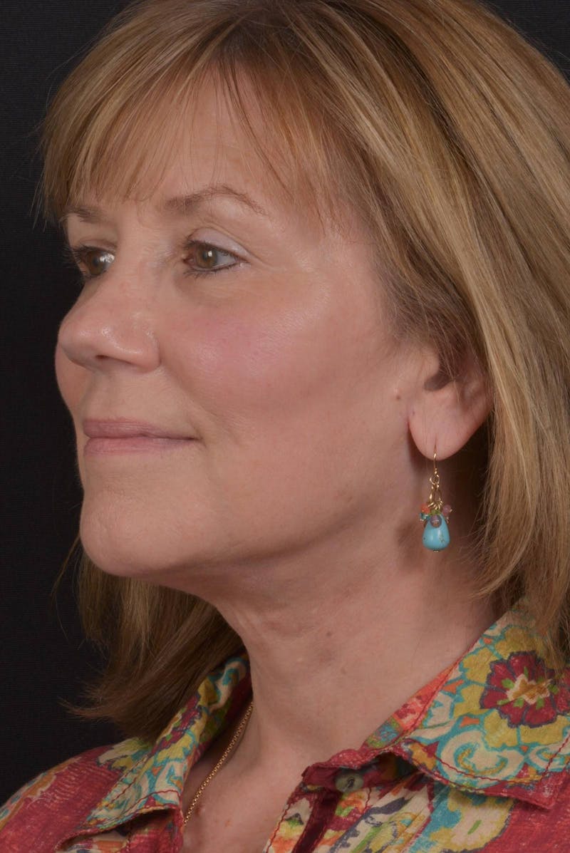 Facelift Before & After Gallery - Patient 407731 - Image 4