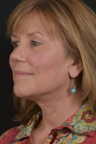 Facelift Before & After Gallery - Patient 407731 - Image 4