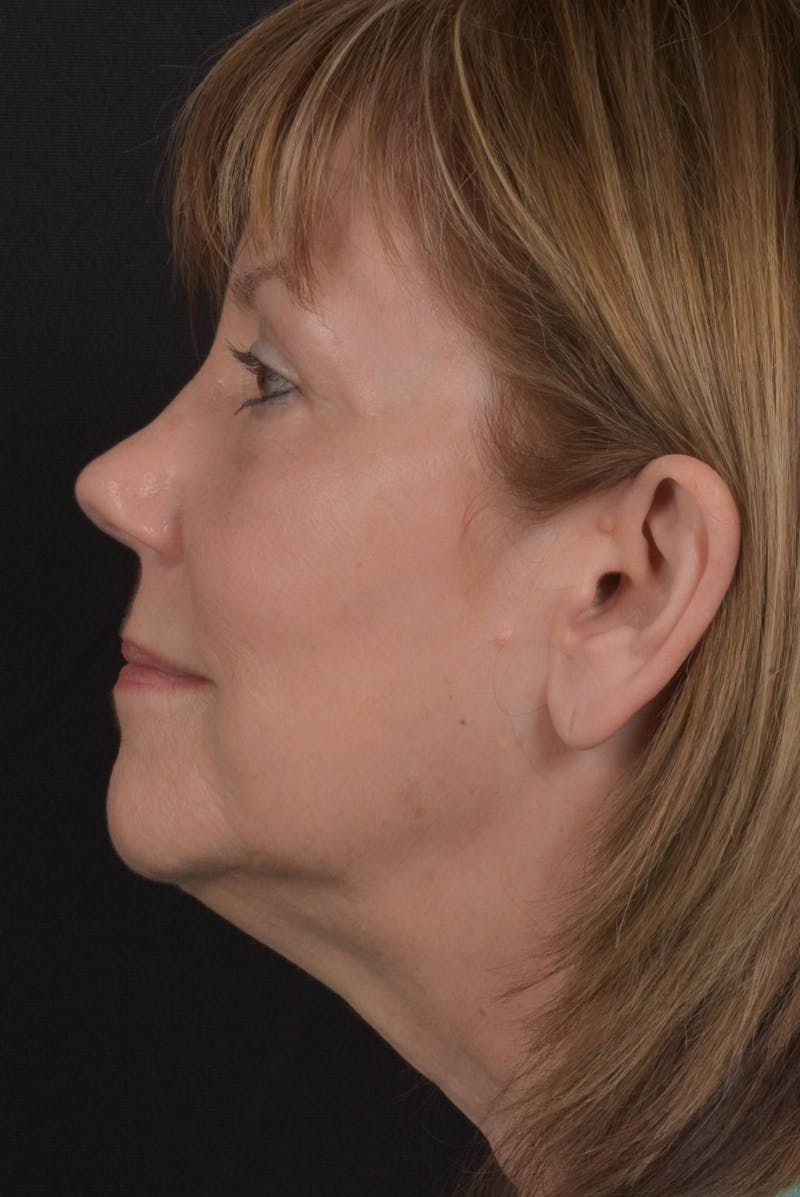 Facelift Before & After Gallery - Patient 407731 - Image 5