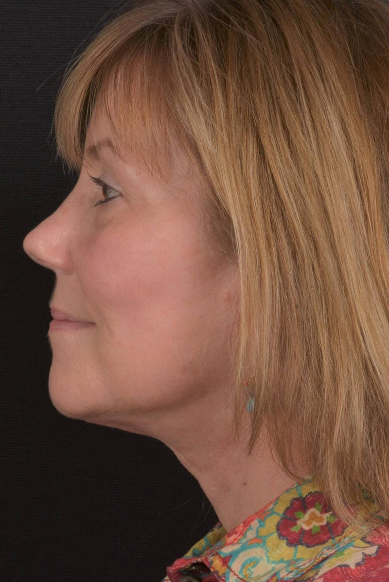 Facelift Before & After Gallery - Patient 407731 - Image 6