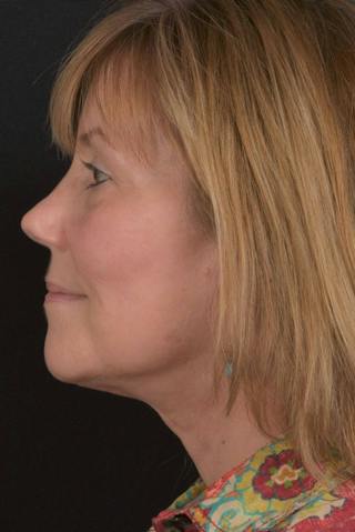 Facelift Before & After Gallery - Patient 407731 - Image 6