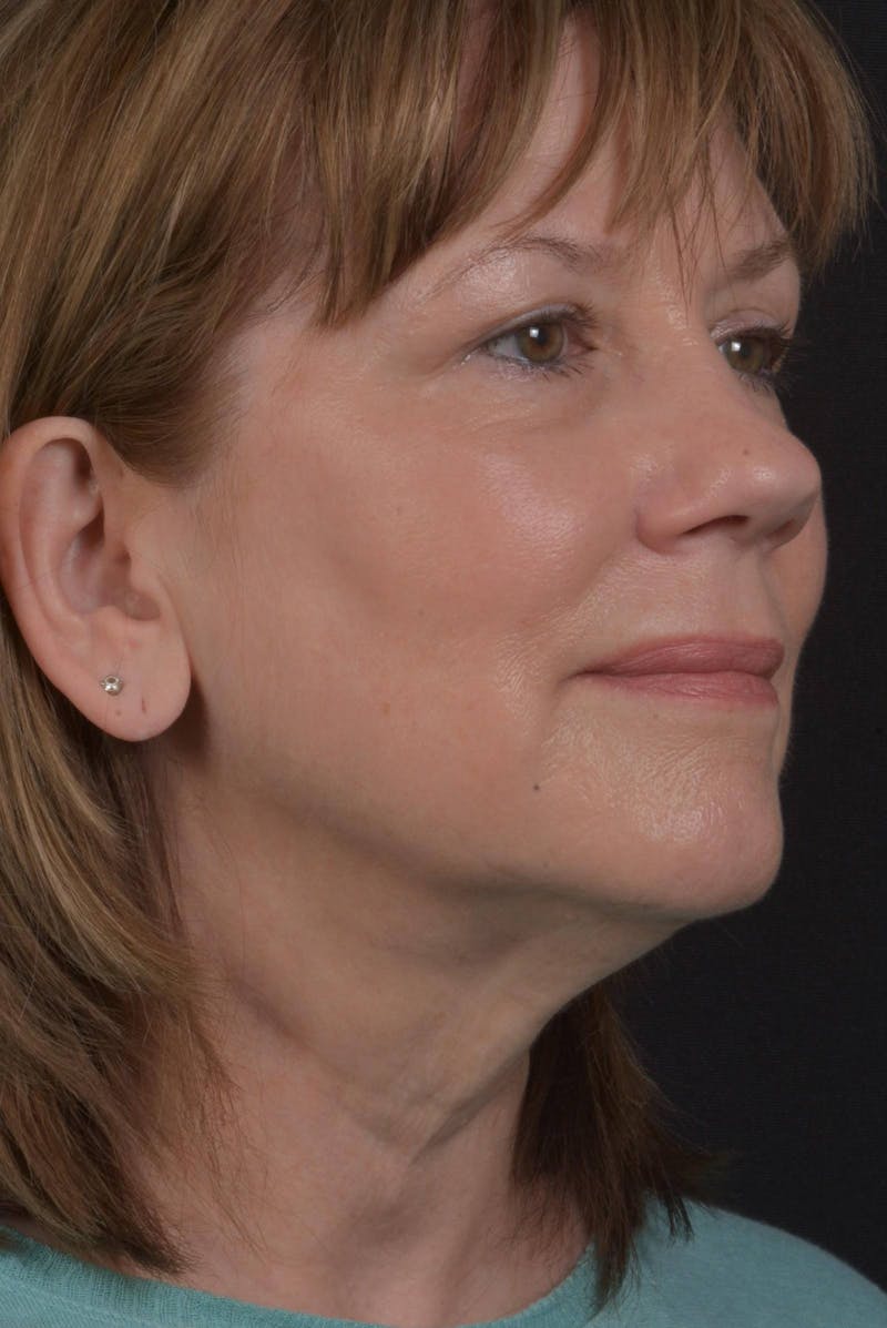 Facelift Before & After Gallery - Patient 407731 - Image 7