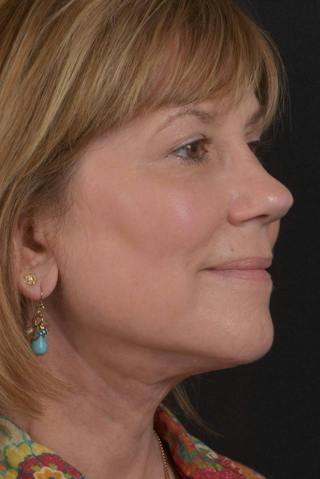 Facelift Before & After Gallery - Patient 407731 - Image 8