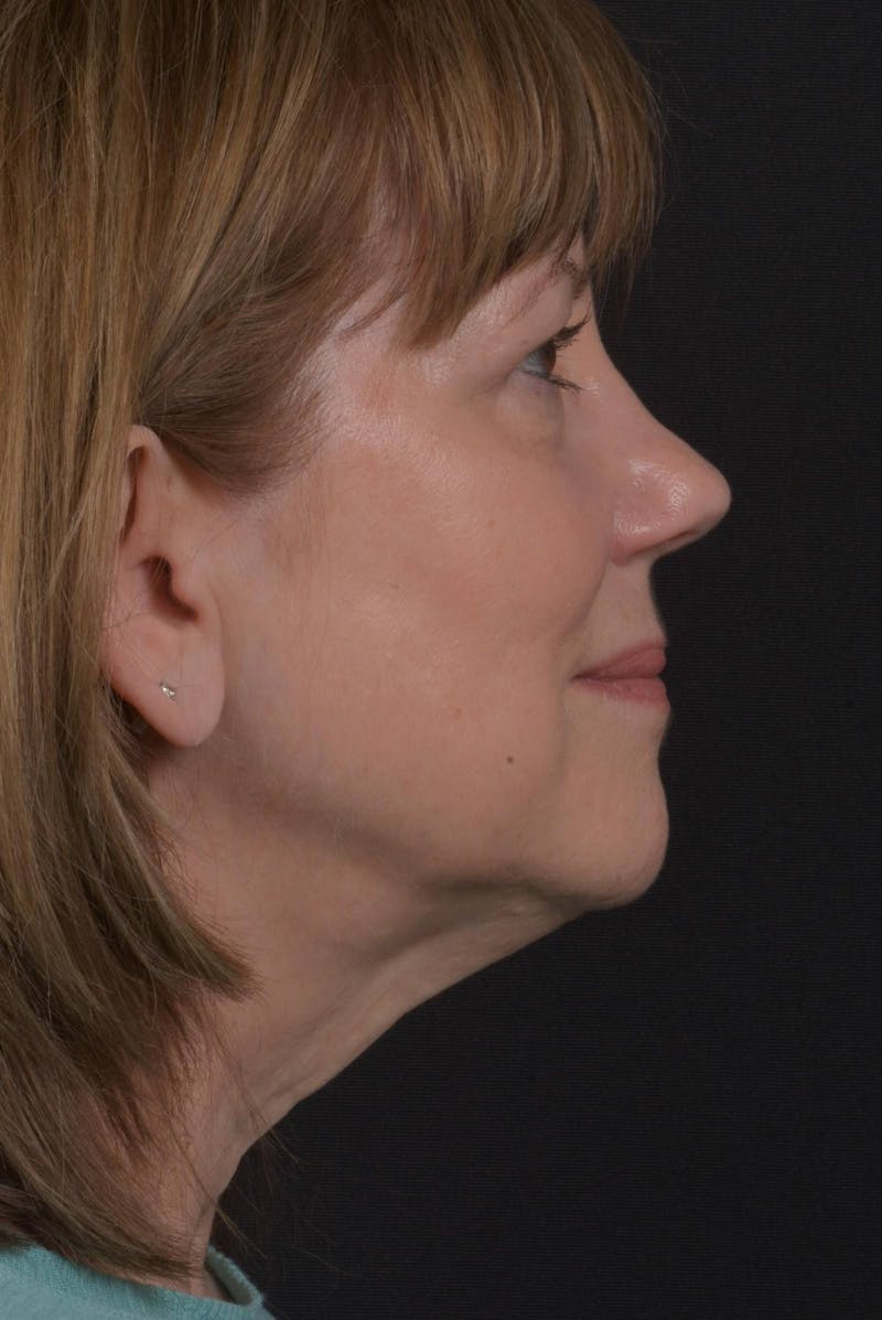Facelift Before & After Gallery - Patient 407731 - Image 9