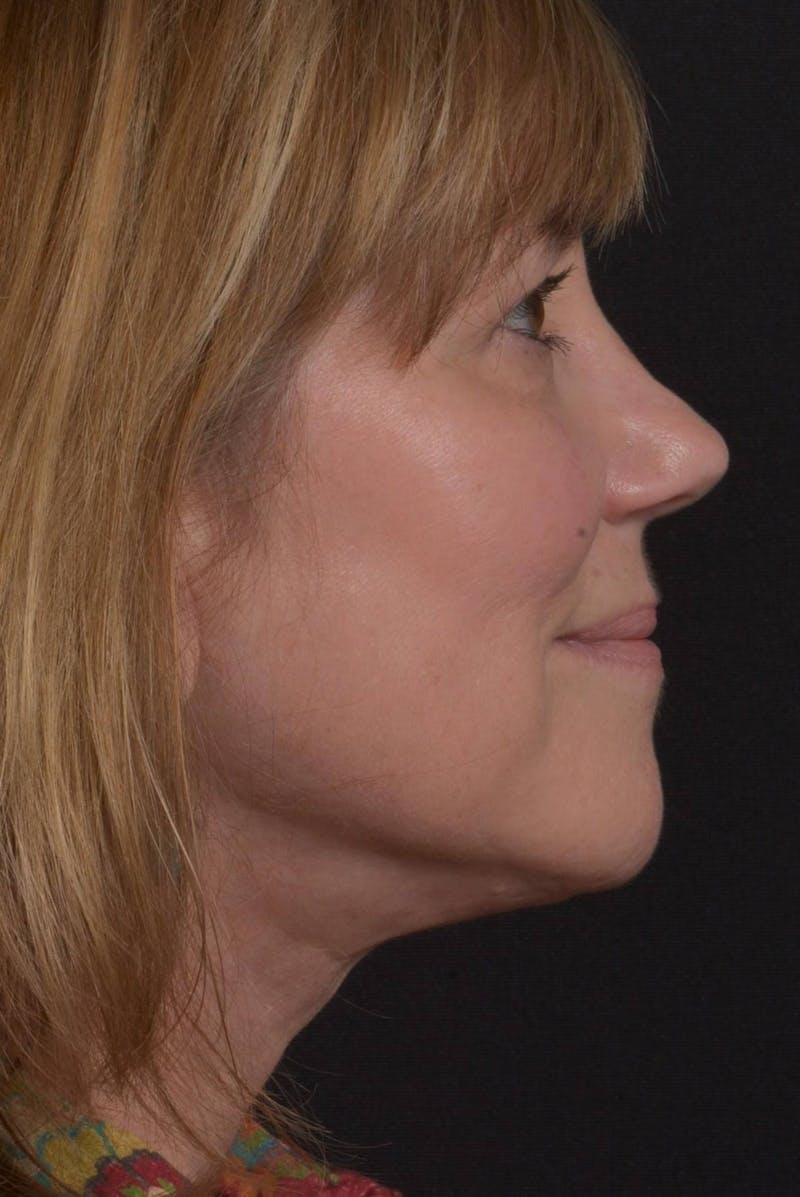Facelift Before & After Gallery - Patient 407731 - Image 10