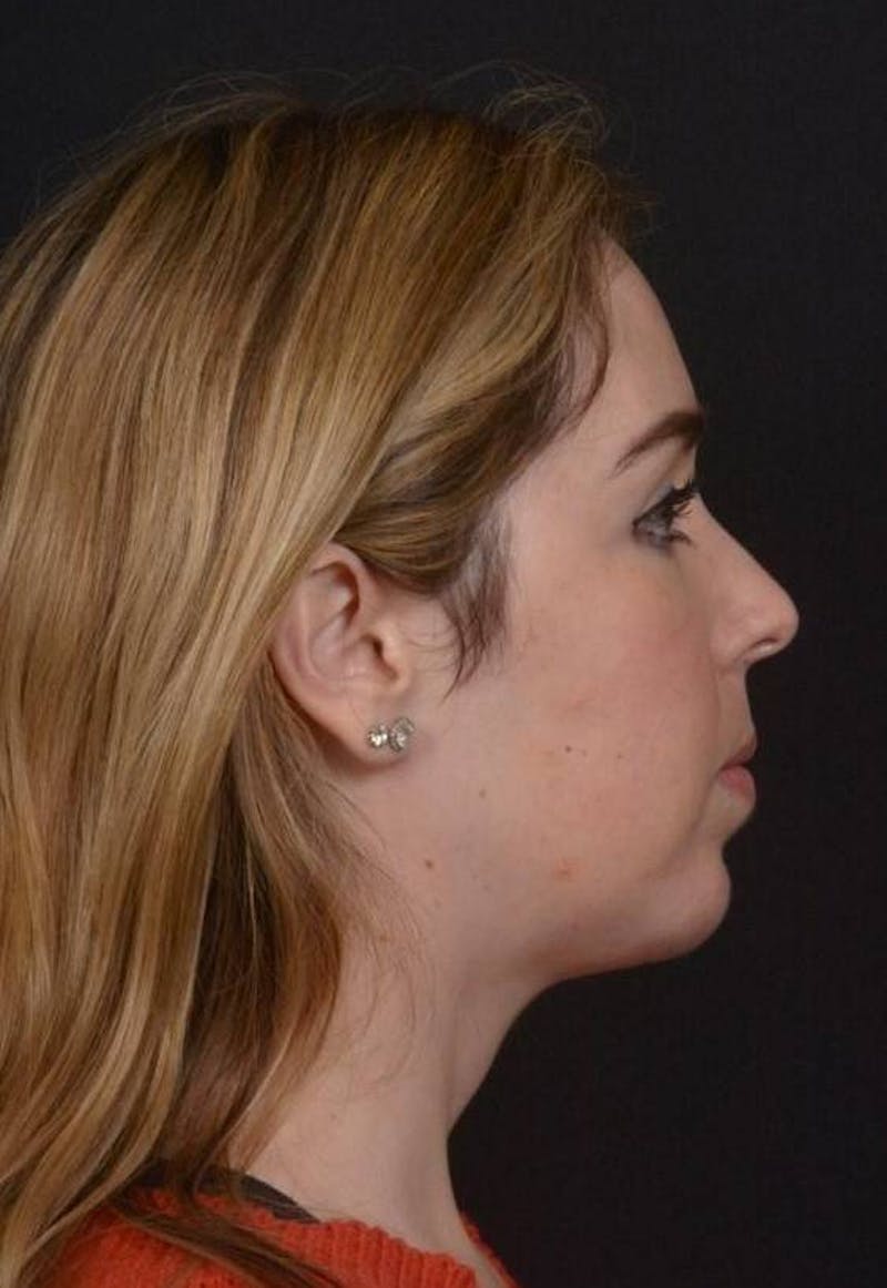 Facelift Before & After Gallery - Patient 139631 - Image 8