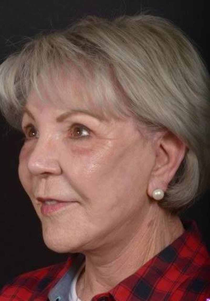 Facelift Before & After Gallery - Patient 101724 - Image 4