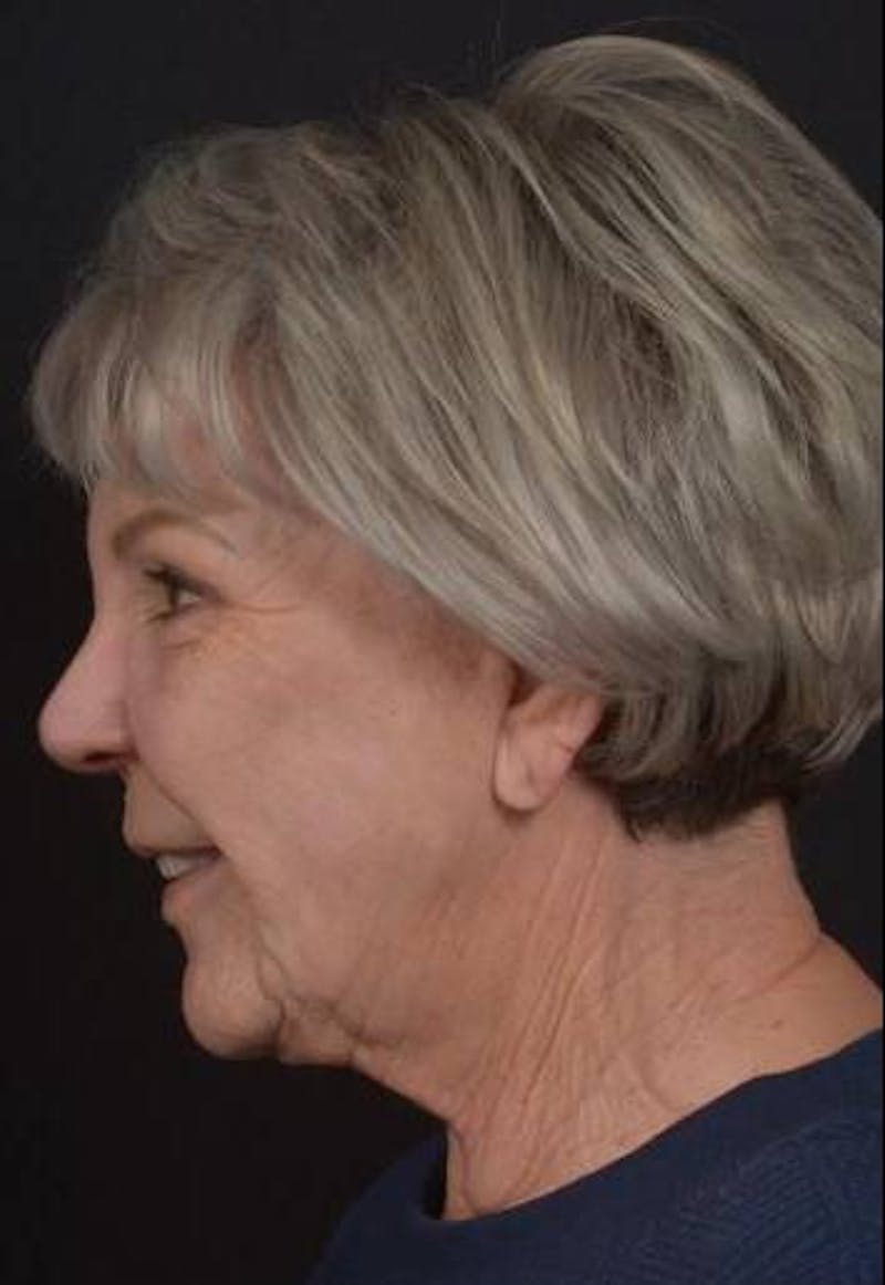 Facelift Before & After Gallery - Patient 101724 - Image 5