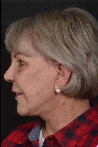 Facelift Before & After Gallery - Patient 101724 - Image 6