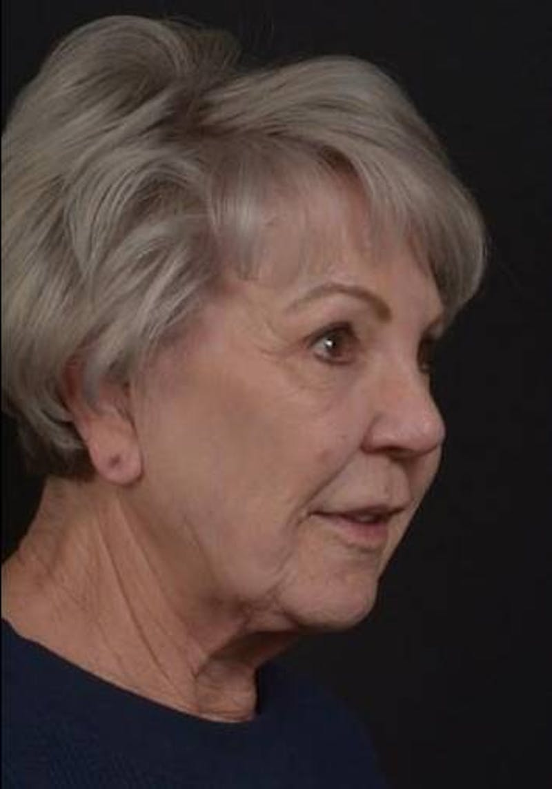 Facelift Before & After Gallery - Patient 101724 - Image 7
