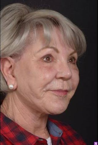 Facelift Before & After Gallery - Patient 101724 - Image 8