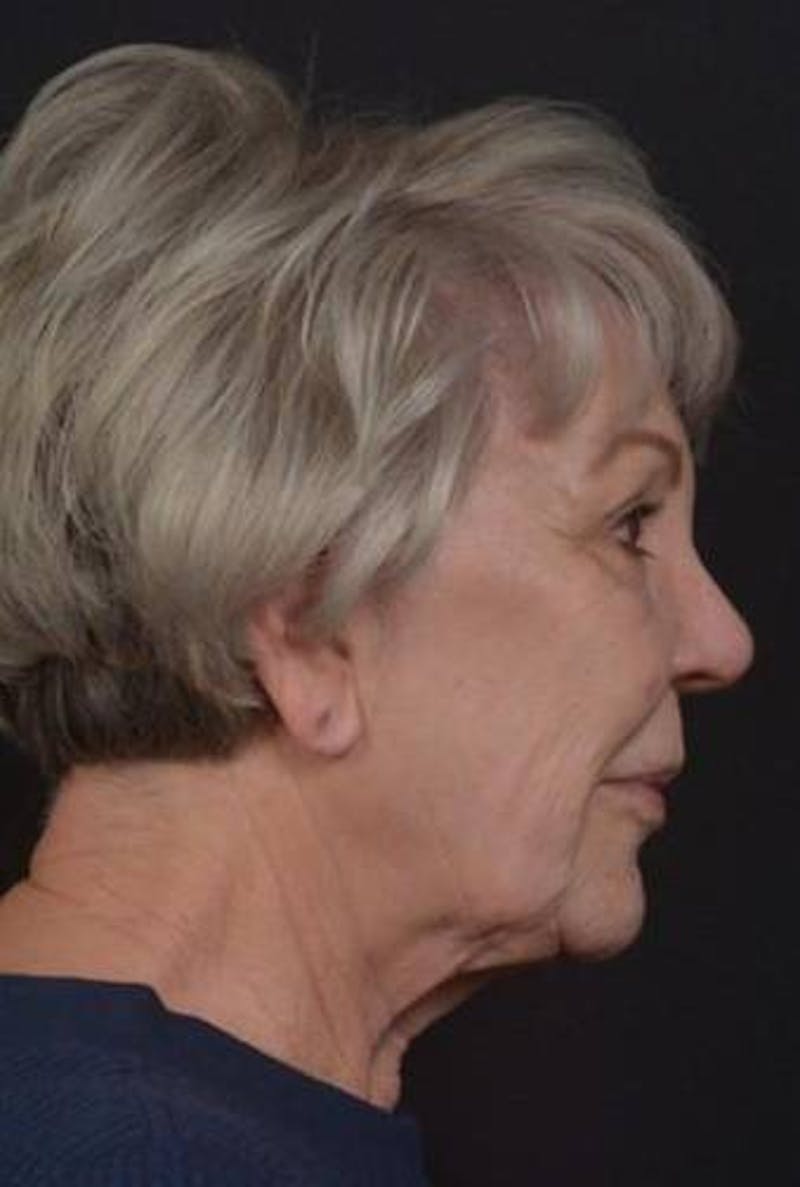 Facelift Before & After Gallery - Patient 101724 - Image 9