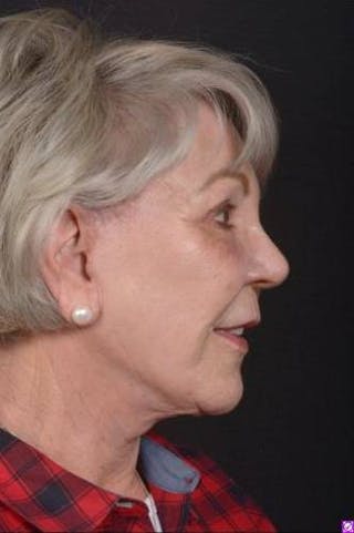 Facelift Before & After Gallery - Patient 101724 - Image 10